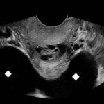 Ovary Hyperstim. Trans Pelvis US Annotated. JETem 2026