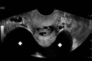 Ovary Hyperstim. Trans Pelvis US Annotated. JETem 2026