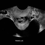 Ovary Hyperstim. Trans Pelvis US Unannotated. JETem 2026