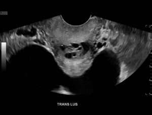 Ovary Hyperstim. Trans Pelvis US Unannotated. JETem 2026