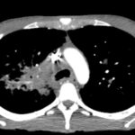 Sarcoidosis CT. JETem 2026