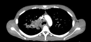Sarcoidosis CT. JETem 2026