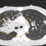 Sarcoidosis CT. Lung View Annotated. JETem 2026