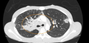 Sarcoidosis CT. Lung View Annotated. JETem 2026