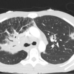 Sarcoidosis CT. Lung View. JETem 2026