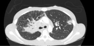 Sarcoidosis CT. Lung View. JETem 2026