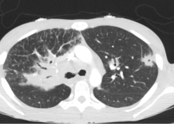 Sarcoidosis CT. Lung View. JETem 2026