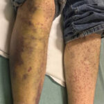 Scurvy Linked to Food Insecurity. Photo A. Annotated. JETem 2026