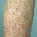 Scurvy Linked to Food Insecurity. Photo C. Annotated. JETem 2026