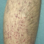 Scurvy Linked to Food Insecurity. Photo C. Unannotated. JETem 2026