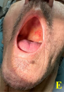 Scurvy Linked to Food Insecurity. Photo E. Annotated. JETem 2026