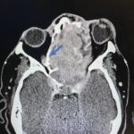 Sinonasal Carcinoma. CT Axial 1 Annotated. JETem 2026