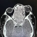 Sinonasal Carcinoma. CT Axial 1. JETem 2026