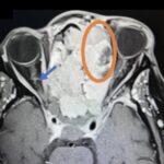 Sinonasal Carcinoma. CT Axial 2 Annotated. JETem 2026