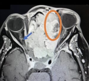 Sinonasal Carcinoma. CT Axial 2 Annotated. JETem 2026