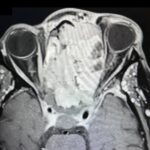 Sinonasal Carcinoma. CT Axial 2. JETem 2026
