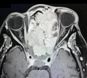 Sinonasal Carcinoma. CT Axial 2. JETem 2026