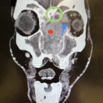 Sinonasal Carcinoma. CT Coronal Annotated. JETem 2026