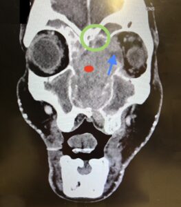 Sinonasal Carcinoma. CT Coronal Annotated. JETem 2026