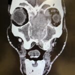 Sinonasal Carcinoma. CT Coronal. JETem 2026