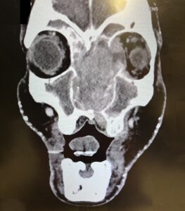 Sinonasal Carcinoma. CT Coronal. JETem 2026