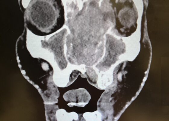 Sinonasal Carcinoma. CT Coronal. JETem 2026