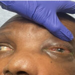 Sinonasal Carcinoma. Photo 3. JETem 2026