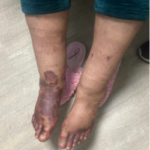 The Rash Vasculitis Photo 1. JETem 2026