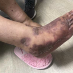 The Rash Vasculitis Photo 2. JETem 2026