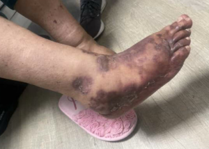 The Rash Vasculitis Photo 2. JETem 2026