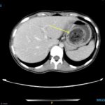 Trapped in Transit Bezoar in Gastric Fundus. CT Axial. Annotated. JETem 2026