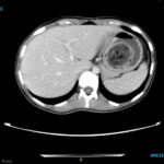Trapped in Transit Bezoar in Gastric Fundus. CT Axial. Unnnotated. JETem 2026