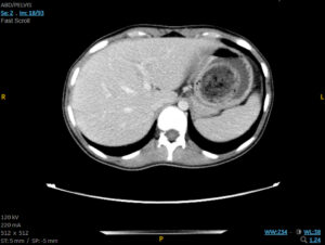 Trapped in Transit Bezoar in Gastric Fundus. CT Axial. Unnnotated. JETem 2026