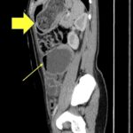 Trapped in Transit Dilated Loops of Small Bowel LUQ. CT Sagital. Annotated. JETem 2026