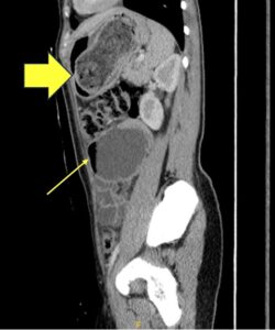 Trapped in Transit Dilated Loops of Small Bowel LUQ. CT Sagital. Annotated. JETem 2026