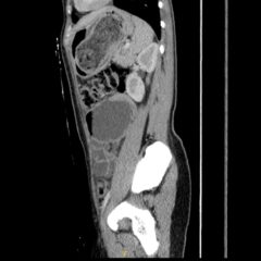 Trapped in Transit Dilated Loops of Small Bowel LUQ. CT Sagital. Unannotated. JETem 2026