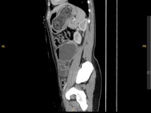 Trapped in Transit Dilated Loops of Small Bowel LUQ. CT Sagital. Unannotated. JETem 2026