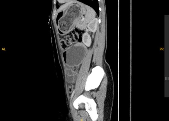 Trapped in Transit Dilated Loops of Small Bowel LUQ. CT Sagital. Unannotated. JETem 2026