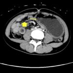 Trapped in Transit Dilated Small Bowel Distal to Bezoar. CT Axial. Annotated. JETem 2026
