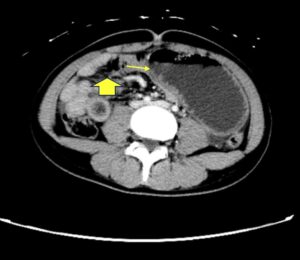 Trapped in Transit Dilated Small Bowel Distal to Bezoar. CT Axial. Annotated. JETem 2026