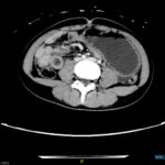 Trapped in Transit Dilated Small Bowel Distal to Bezoar. CT Axial. Unannotated. JETem 2026