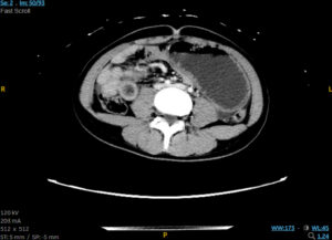 Trapped in Transit Dilated Small Bowel Distal to Bezoar. CT Axial. Unannotated. JETem 2026
