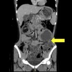 Trapped in Transit Lead Point of SBO. CT Coronal. Annotated. JETem 2026