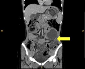 Trapped in Transit Lead Point of SBO. CT Coronal. Annotated. JETem 2026