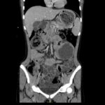 Trapped in Transit Lead Point of SBO. CT Coronal. Unannotated. JETem 2026