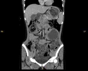 Trapped in Transit Lead Point of SBO. CT Coronal. Unannotated. JETem 2026