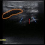 Bilateral Quadriceps Tendon Rupture. Left Long Knee US Annotated. JETem 2026