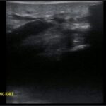 Bilateral Quadriceps Tendon Rupture. Left Long Knee US. JETem 2026