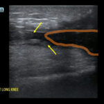 Bilateral Quadriceps Tendon Rupture. Right Long Knee US Annotated. JETem 2026