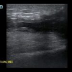 Bilateral Quadriceps Tendon Rupture. Right Long Knee US. JETem 2026